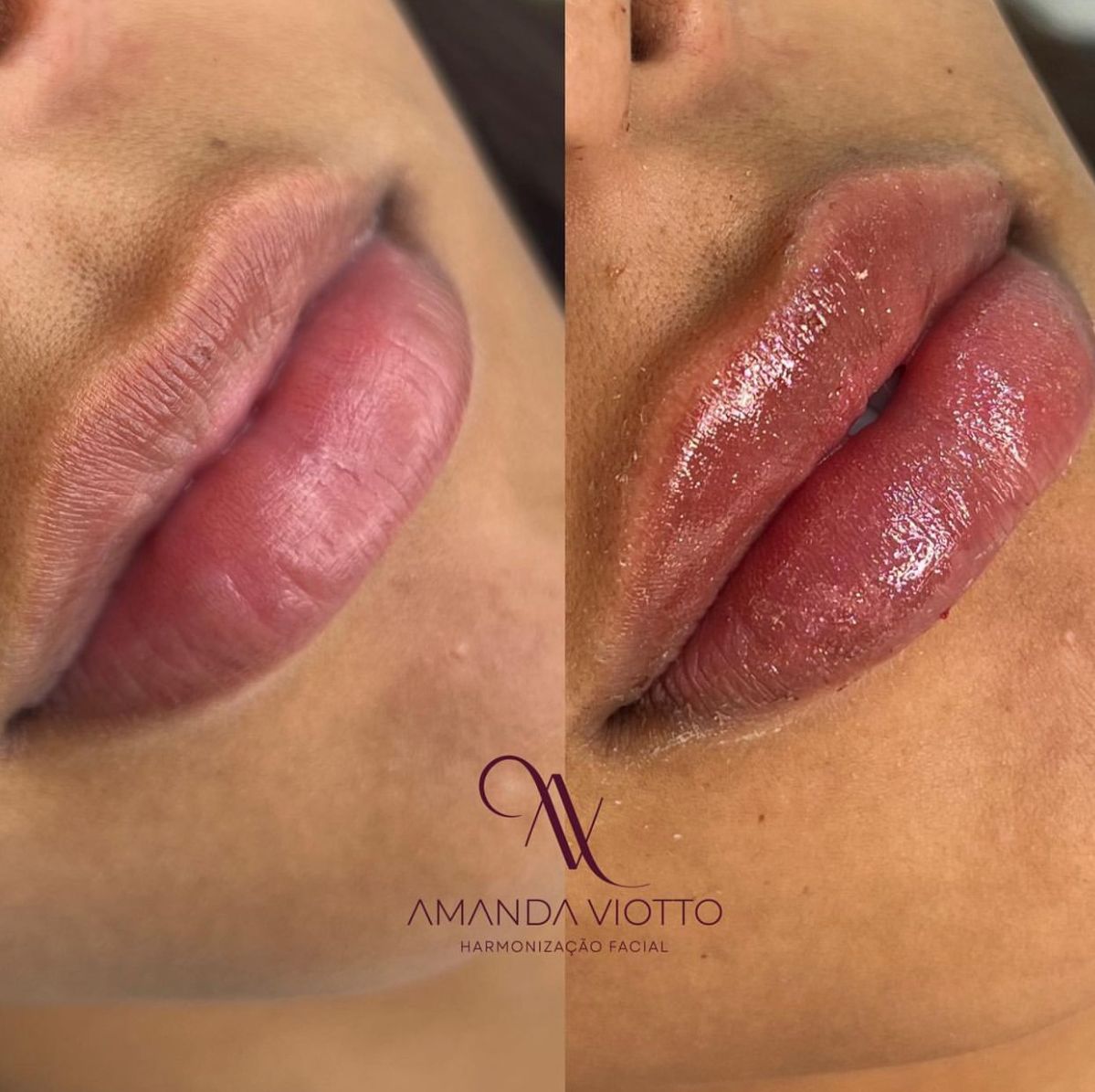 Resultado antes e depois 2